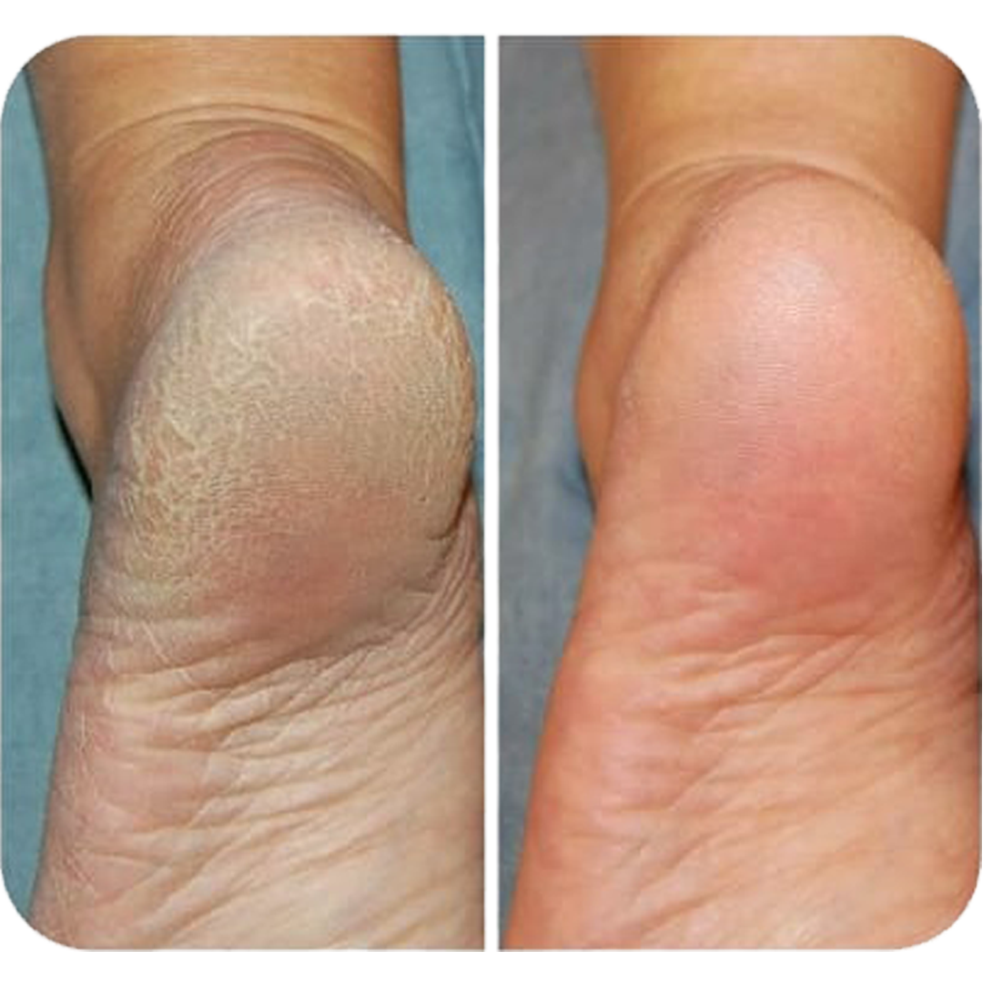 Before and After