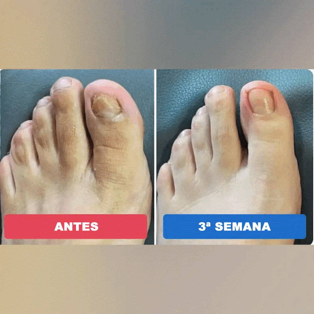 Cortares™ – Adesivo Antifúngico para Unhas