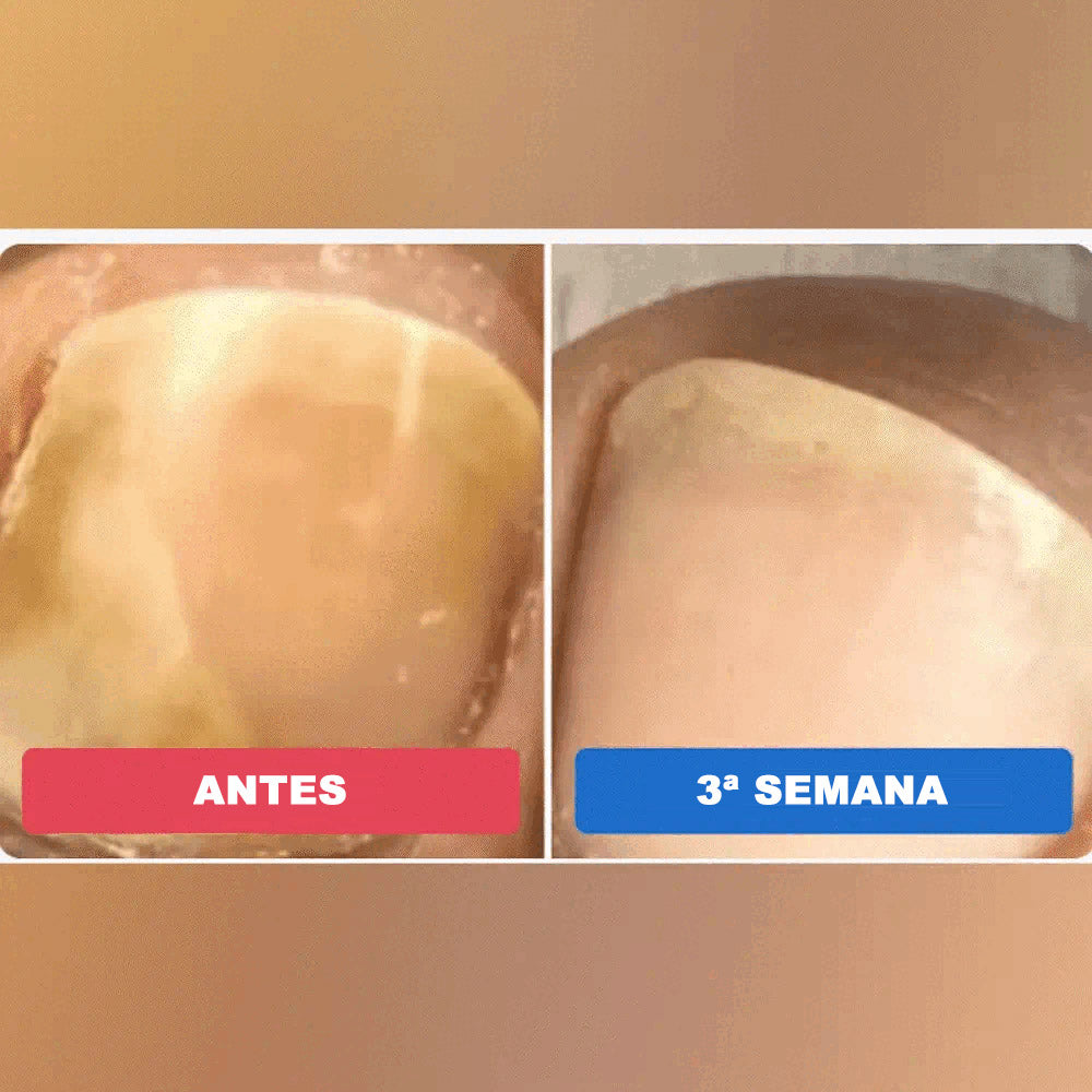 Cortares™ – Adesivo Antifúngico para Unhas