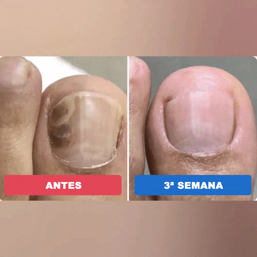 Cortares™ – Adesivo Antifúngico para Unhas