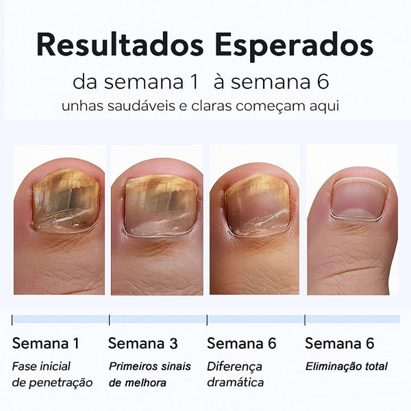 Cortares™ – Adesivo Antifúngico para Unhas